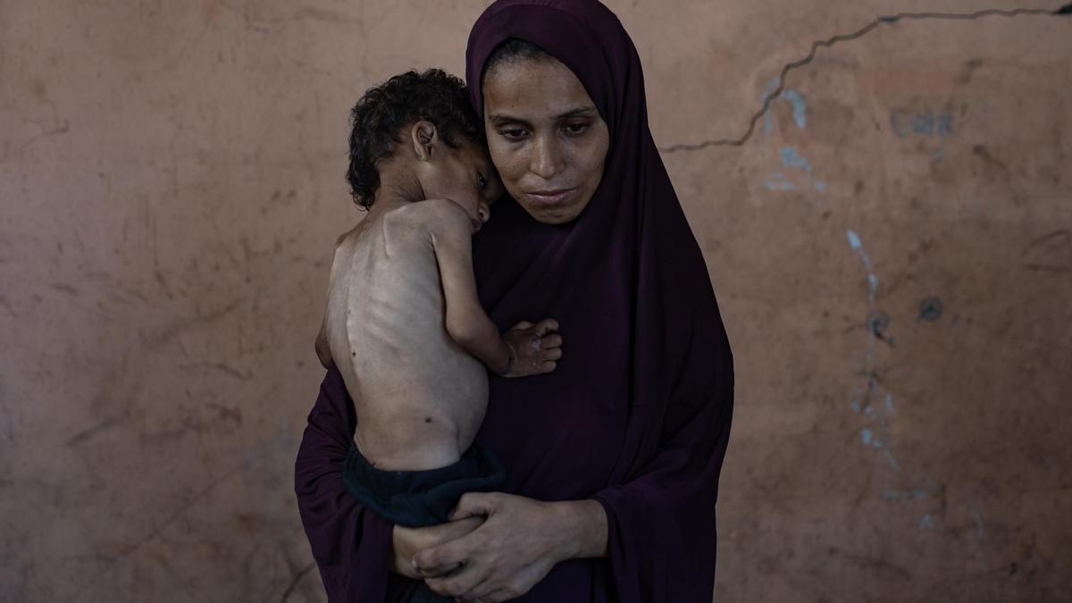 Niño gazatí que sufre malnutrición a causa del bloqueo y el cierre de fronteras por parte de Israel