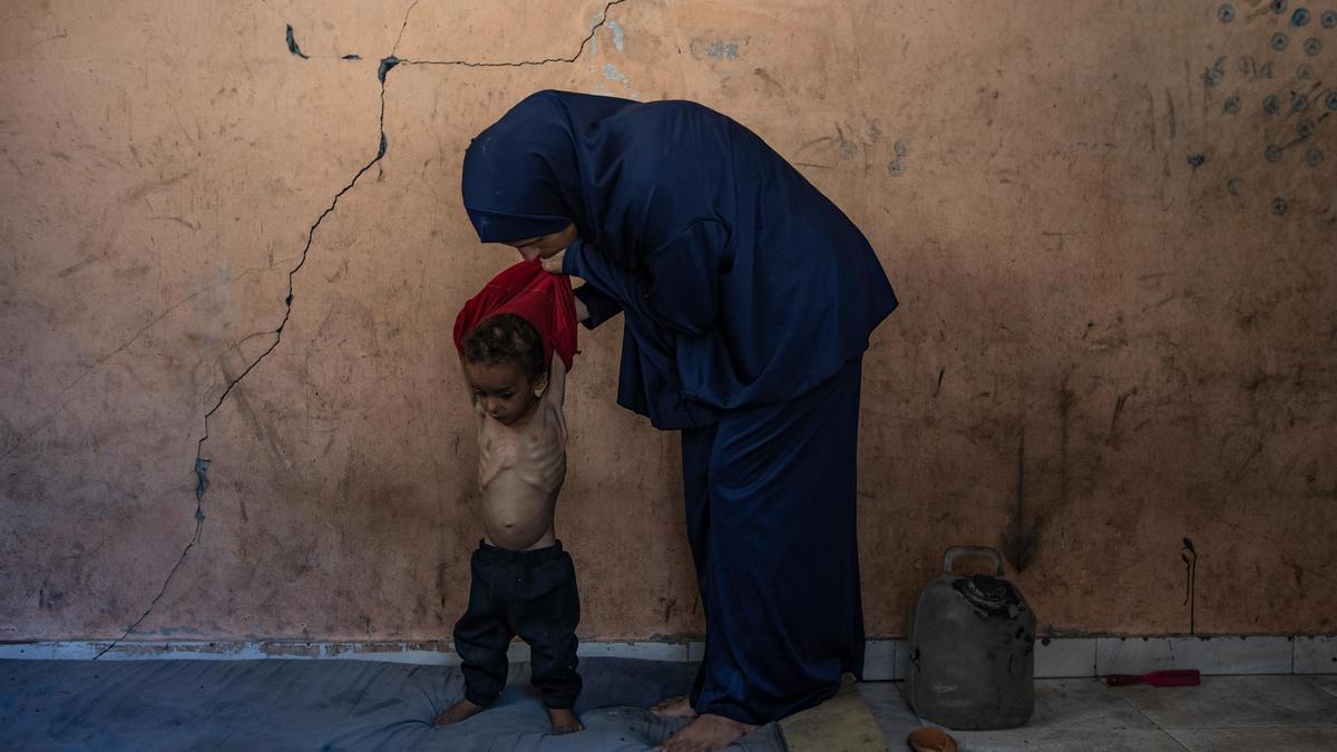 El niño palestino Yazan Abu Foul, de dos años, está al cuidado de su madre Naima, ya que sufre desnutrición severa debido a la aguda escasez de alimentos causada por el bloqueo impuesto a la Franja de Gaza y el cierre de los cruces fronterizos.