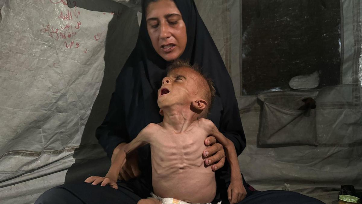 La crisis por desnutrición en Gaza ganó visibilidad con imágenes como las del pequeño Mohamed Motawaq, de tripa hinchada y brazos esqueléticos.