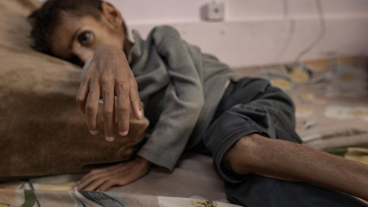 Un niño que sufre malnutrición en Gaza.